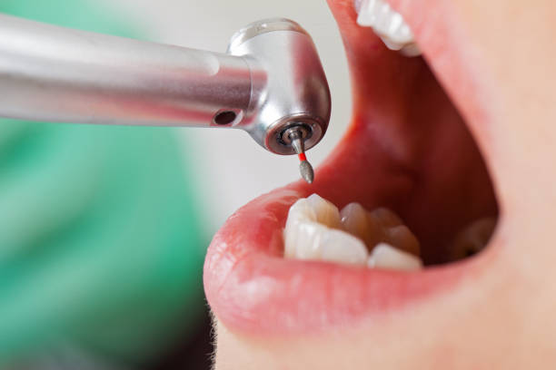 Best Emergency Root Canal Treatment in Island City, OR
